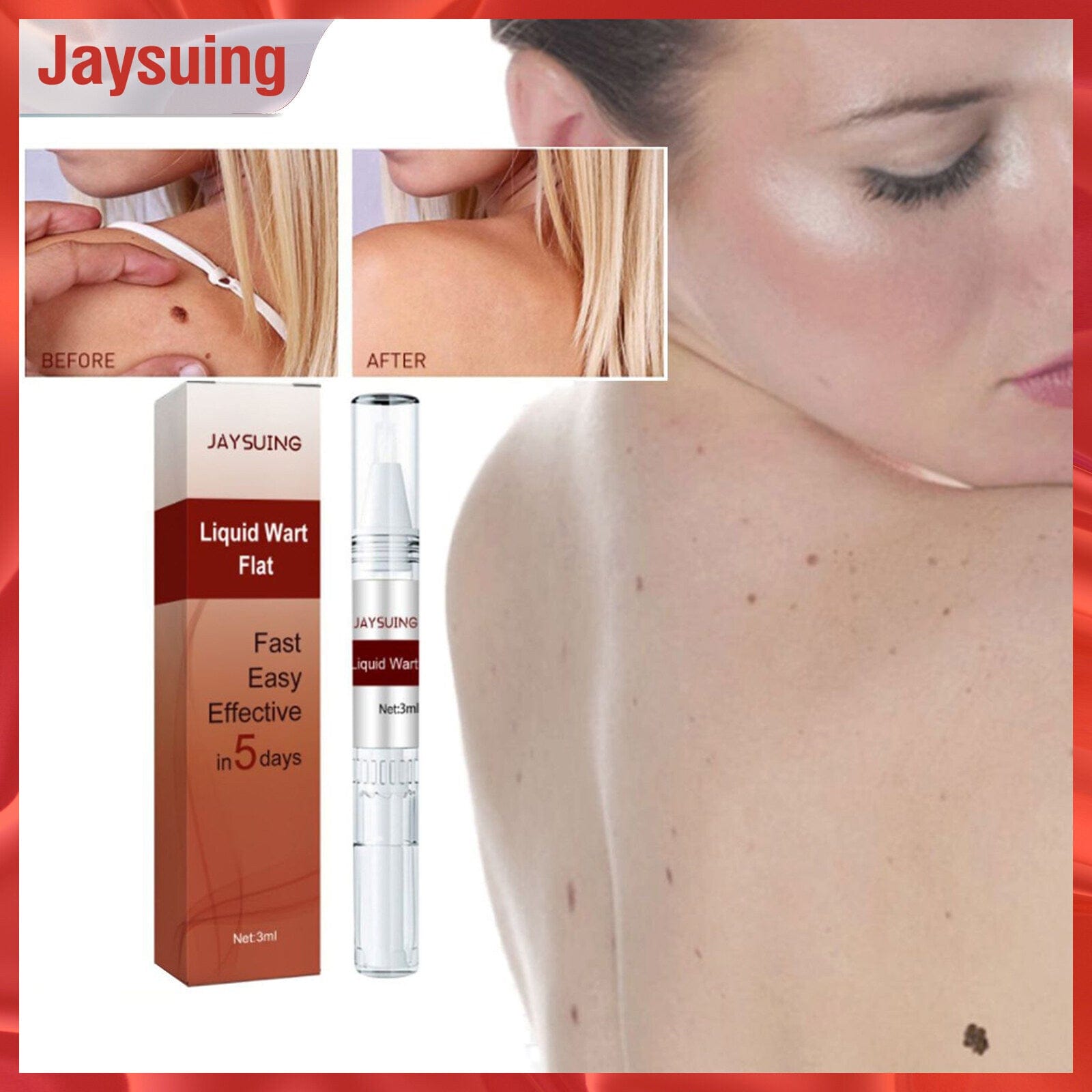 Professional Skin Tag & Mole Removal Device – Flawless Skin At Home - Vistora